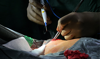 pacemaker implantation in south delhi