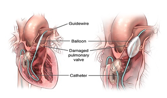 balloon mitral valvotomy treatment in south delhi